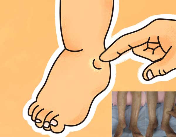 足のむくみ（浮腫）の写真とイラスト